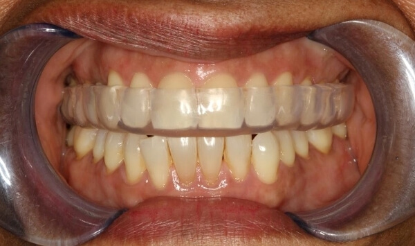 Головний симптом бруксизма - це коли людина   уві сні скрипить зубами   (Скрегіт при мимовільному і сильному скороченні м'язів щелеп)